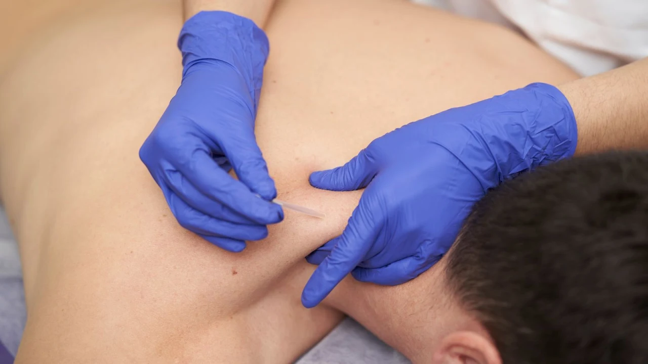 العلاج بالإبر الجافة وتحرير نقاط الألم العضلي (Dry Needling)