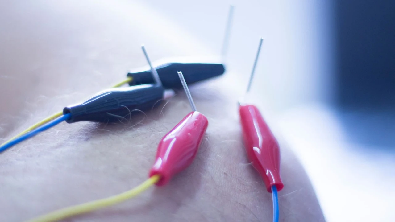 العلاج بالإبر الجافة وتحرير نقاط الألم العضلي (Dry Needling)